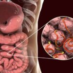 Diseases Caused by Parasites